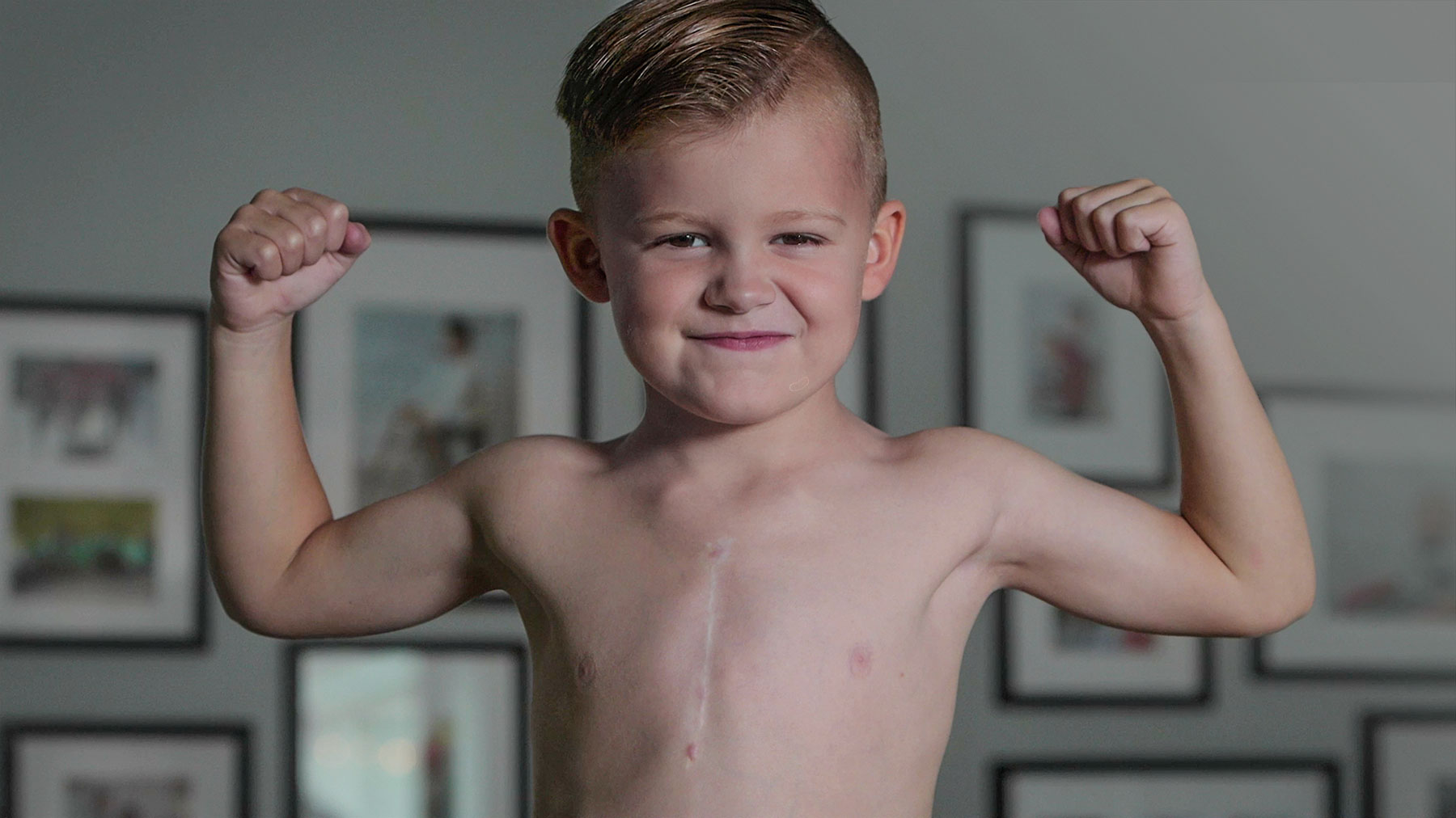 An image of a young boy (maybe 5 years old) with no shirt on pumping both fists with a very confident and strong look on his face. You can you can see his heart surgery scar down the middle of his chest. He is proud to show it off.
